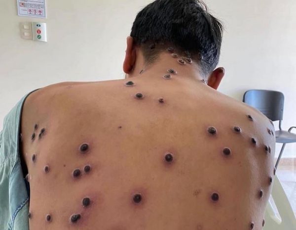 Mpox – ΕΟΔΥ: Όλα όσα πρέπει να γνωρίζουν οι ταξιδιώτες – Συμπτώματα και μέτρα προστασίας